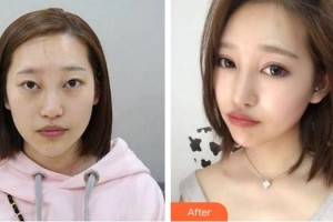 廈門大學(xué)附屬廈門眼科中心醫(yī)院何歡整形價(jià)格表附變身大眼“氣質(zhì)女孩”案例展示