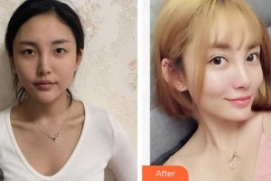 廈門大學(xué)附屬廈門眼科中心醫(yī)院楊梅整形價(jià)格表附眼部手術(shù)案例展示