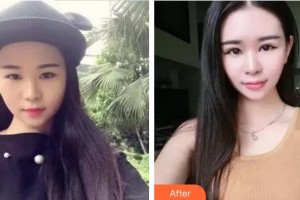 廈門大學(xué)附屬廈門眼科中心醫(yī)院沈政偉整形價(jià)格表附雙眼皮修復(fù)快三個(gè)月案例展示