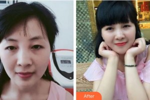 廈門大學(xué)附屬廈門眼科中心醫(yī)院揭黎明整形價(jià)格表附雙眼皮案例展示