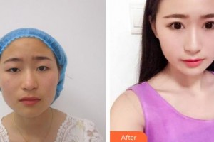 廈門大學(xué)附屬廈門眼科中心醫(yī)院黃艷明整形價格表附眼部整形案例展示