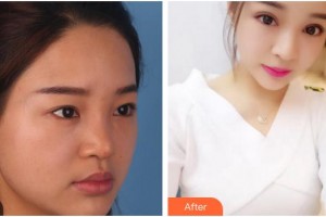 廈門大學(xué)附屬廈門眼科中心醫(yī)院陳燕整形價格表附全切雙眼皮案例展示