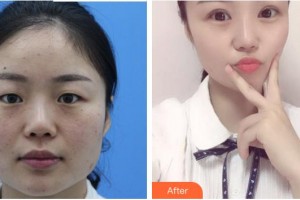 廈門大學(xué)附屬廈門眼科中心醫(yī)院江國華整形價格表附一眼愛上你的雙眼皮案例展示