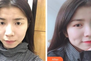 廈門大學(xué)附屬廈門眼科中心醫(yī)院李海波整形價格表附眼部案例展示