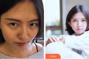 廈門大學(xué)附屬廈門眼科中心醫(yī)院康克明整形價格表附切開雙眼皮案例展示