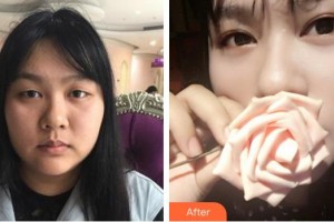 廈門大學(xué)附屬廈門眼科中心醫(yī)院張小虎整形價格表附切開雙眼皮案例展示