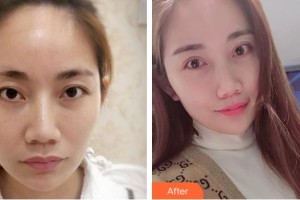 廈門大學(xué)附屬廈門眼科中心醫(yī)院鄭林整形價格表附定點(diǎn)雙眼皮案例展示