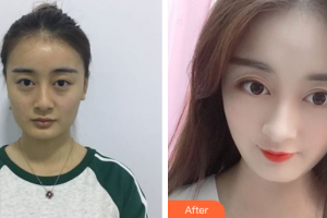 廣州中科美整形醫(yī)院陳美運(yùn)整形價(jià)格表附假體隆鼻案例展示