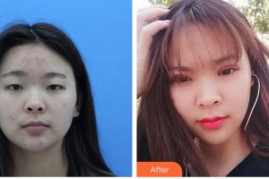 廈門大學(xué)附屬廈門眼科中心醫(yī)院羅向東整形價格表附切開雙眼皮案例展示