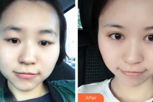 廈門大學(xué)附屬廈門眼科中心醫(yī)院劉名威整形價格表附眼部整形案例展示