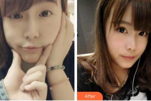 廈門大學(xué)附屬?gòu)B門眼科中心醫(yī)院雷雨住院醫(yī)師整形價(jià)格表附切開雙眼皮案例展示