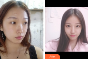 廣州中科美整形醫(yī)院徐長亮整形價(jià)格表附祛疤痕案例展示