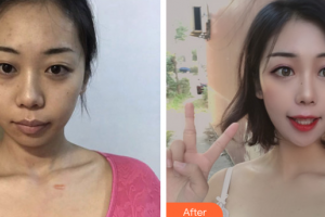 廣州伊麗莎白醫(yī)學(xué)美容門診部鄭國蘭整形價(jià)格表附增生疤痕案例展示