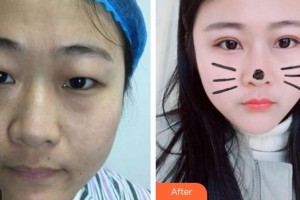 廈門科宏眼科醫(yī)院劉俠整形價(jià)格表附單眼皮變雙眼皮案例展示