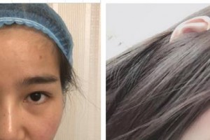 廈門科宏眼科醫(yī)院白晶晶整形價(jià)格表附雙眼皮案例展示