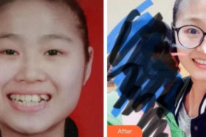 廈門醫(yī)學(xué)院附屬口腔醫(yī)院李水根整形價(jià)格表附牙齒矯正案例展示