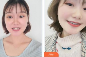 廈門鉑菲特口腔門診部劉保留整形價格表附牙齒矯正案例展示