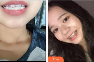 廈門鉑菲特口腔門診部鄭美玲整形價格表附金屬托槽矯正案例展示