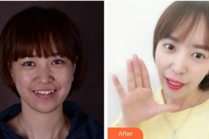 廈門鉑菲特口腔門診部王鈺姬整形價格表附隱形矯正案例展示