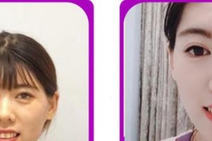 廈門峰煜口腔門診部曹尚軍整形價格表附牙齒隱形矯正案例展示