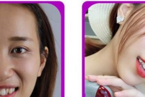 廈門現(xiàn)代口腔門診部鞏炳含整形價格表附牙齒矯正案例展示