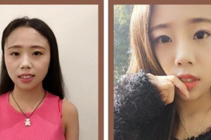 廈門麥芽口腔醫(yī)院馬紅梅整形價格表附隱形托槽矯正案例展示