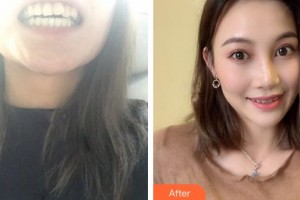 廈門麥芽口腔醫(yī)院姚江武整形價格表附半隱形矯正案例展示