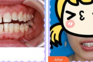 廈門康爾口腔門診部李凱霞整形價格表附隱形矯正案例展示