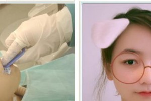 廈門康爾口腔門診部吳達(dá)靈整形價格表附全隱形牙齒矯正案例展示