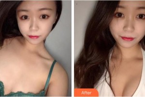 莆田海峽整形美容醫(yī)院沈文鑫整形價格表附濃縮豐胸真實案例展示