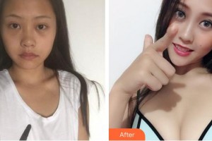 莆田海峽整形美容醫(yī)院洪潤其整形價格表附假體隆胸日記案例展示