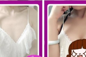 莆田海峽整形美容醫(yī)院南相載整形價格表附深V動感豐胸案例展示