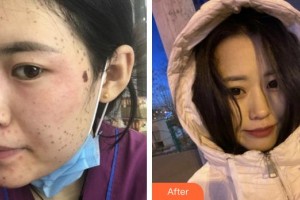 莆田海峽整形美容醫(yī)院傅鳳英整形價格表附超激光美膚祛斑案例展示