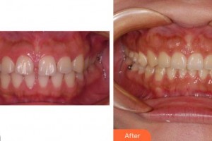 莆田海峽整形美容醫(yī)院張景泉整形價格表附牙齒正畸案例展示