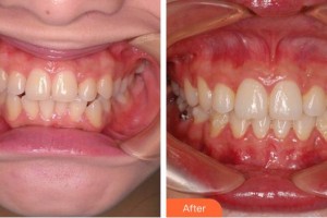 莆田海峽整形美容醫(yī)院孟憲文整形價格表附牙齒正畸案例展示