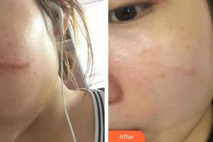 莆田95醫(yī)院整形外科詹新華整形價格表附祛疤案例展示