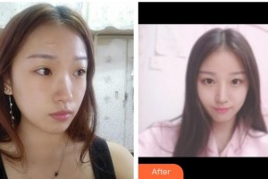 莆田婦產(chǎn)?？漆t(yī)院瑞麗醫(yī)療美容科林必華整形價格表附手術(shù)縫合祛疤案例展示