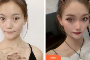 莆田婦產(chǎn)?？漆t(yī)院瑞麗醫(yī)療美容科陳小青整形價格表附疤痕疙瘩案例展示