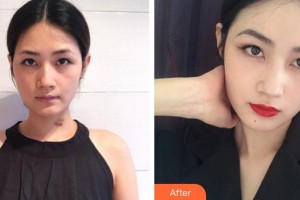 莆田明韓女人花整形美容診所吳建超整形價格表附增生疤痕案例展示