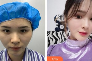 莆田海峽整形美容醫(yī)院魏紫林整形價(jià)格表附鼻部手術(shù)案例展示
