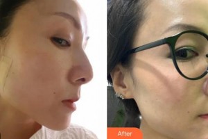 莆田海峽整形美容醫(yī)院陳藝整形價(jià)格表附埋線提升案例展示