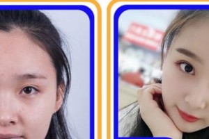 莆田海峽整形美容醫(yī)院申根植整形價(jià)格表附鼻部綜合案例展示