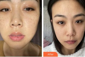 莆田海峽整形美容醫(yī)院陳秀華整形價(jià)格表附激光美膚激光案例展示