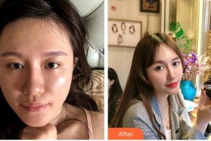 莆田維納斯整形美容門診部時(shí)慧整形價(jià)格表附埋線提升案例展示