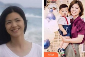 莆田海峽整形美容醫(yī)院朱秀姐整形價(jià)格表附牙齒矯正案例展示