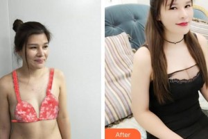 莆田瑞麗整形美容醫(yī)院陳萍住院醫(yī)師整形價(jià)格表附自體脂肪隆胸案例展示