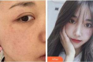 莆田瑞麗整形美容醫(yī)院楊明怡住院醫(yī)師整形價(jià)格表附超激光美膚祛斑案例展示