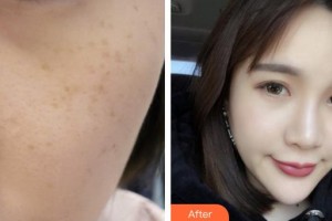 莆田瑞麗整形美容醫(yī)院朱瑛住院醫(yī)師整形價(jià)格表附超激光美膚祛斑案例展示