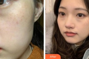 莆田瑞麗整形美容醫(yī)院高明菊住院醫(yī)師整形價(jià)格表附蜂巢激光美膚案例展示