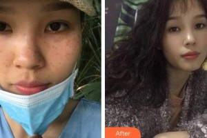 莆田瑞麗整形美容醫(yī)院呂娜住院醫(yī)師整形價(jià)格表附雙激光美膚案例展示